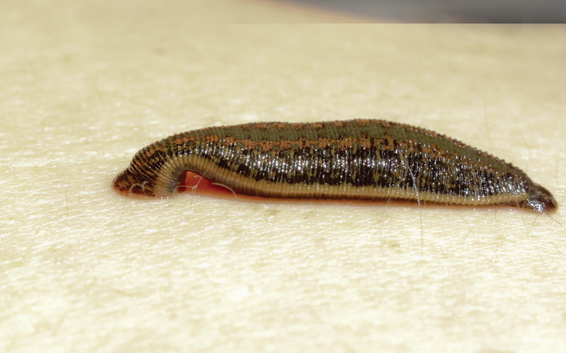 Hirudotherapy: An Opportunity for Healing